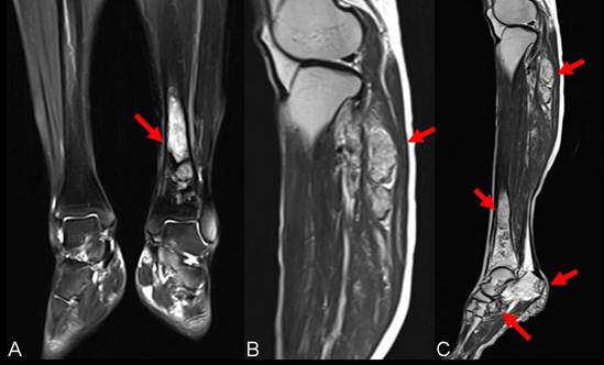 Multicentric Epithelioid Hemangioendothelioma Involving the Same Lower