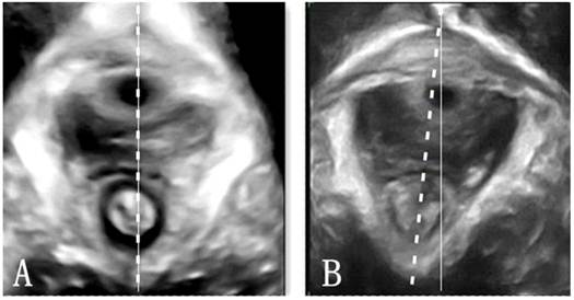 Three-dimensional Ultrasound Appearance Pelvic Floor Nulliparous