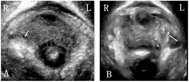 Three-dimensional Ultrasound Appearance of Pelvic Floor in Nulliparous