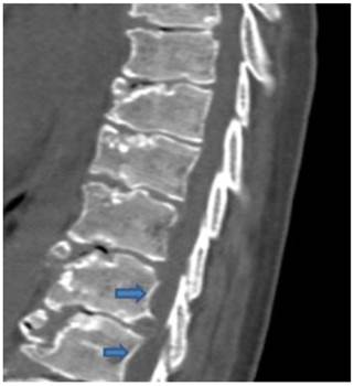 medsci syndrome type