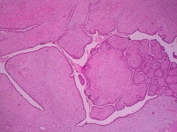 Phyllode Tumor