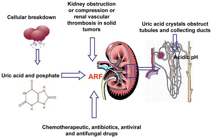 Multifactorial pathogenesis of ARF (Acute Renal Failure)