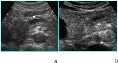 Dilated Pancreatic Duct