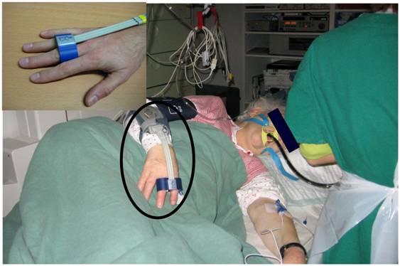 Arterial Pressure Monitoring