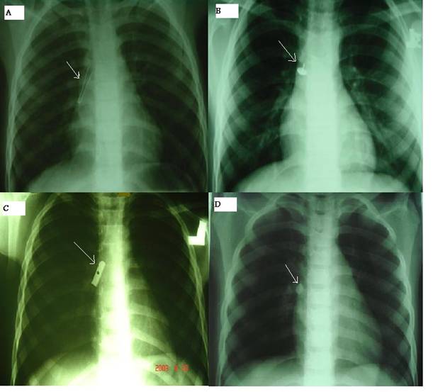 Foreign body aspirations in Infancy a 20year experience