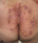 Hidradenitis suppurativa - Wikipedia