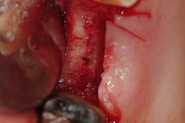 oroantral fistula