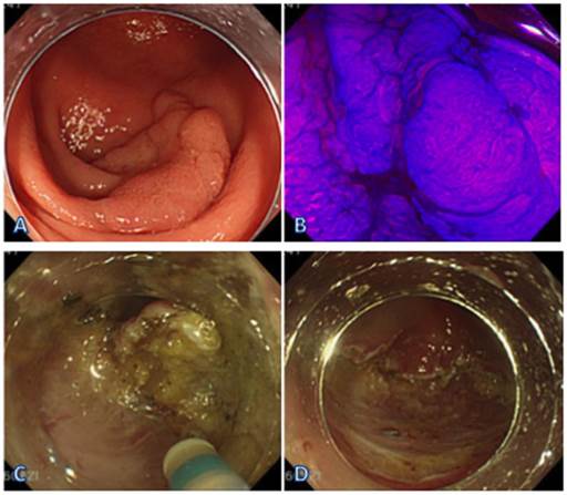 Have Retroflex of anal canal are not Above Retroflex of anal canal seems