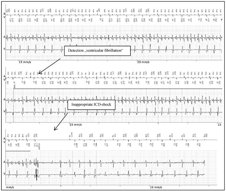 heart failure with atrial fibrillation case study quizlet