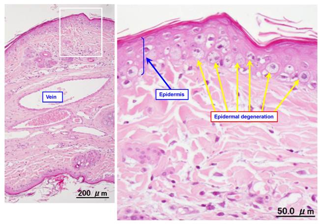 Effect of corticosteroids on phlebitis induced by intravenous infusion ...
