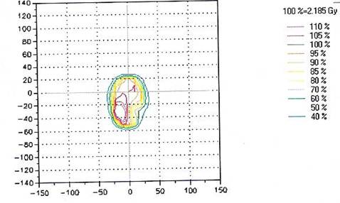 Tumor Size Chart Brain