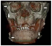 diktator forfriskende pianist Oral and Maxillofacial Considerations in Gardner's Syndrome