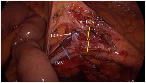 How Much Colonic Redundancy Could Be Obtained by Splenic Flexure