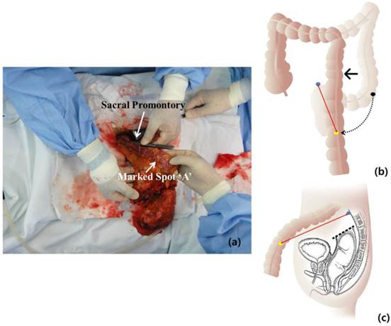 How Much Colonic Redundancy Could Be Obtained by Splenic Flexure
