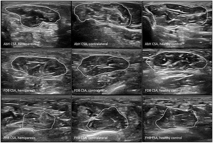 Rehabilitative ultrasound imaging of the bilateral intrinsic plantar