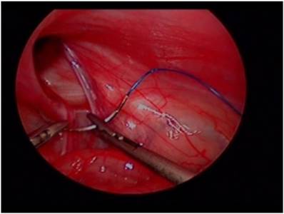Reliability of Preoperative Inguinal Sonography for Evaluating Patency