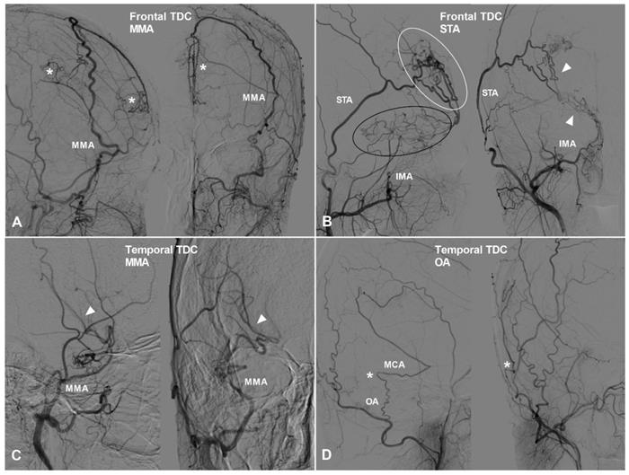 Angiographic study of the transdural collaterals at the anterior