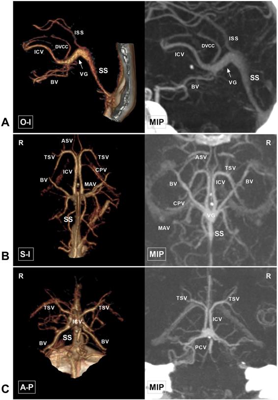 Ct Angiographic Study Of The Cerebral Deep Veins Around The Vein Of Galen